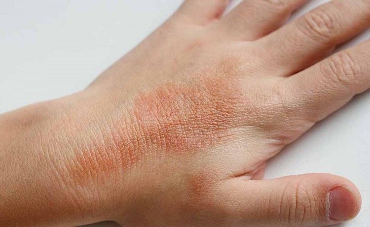 Dermatite Cause Sintomi Rimedi Miagenda Blog